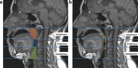 Airway And Soft Palate Measurements On Midsagittal Mri A Segments Of