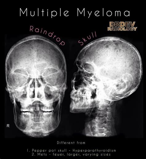Raindrop Skull In Multiple Myeloma Diagnosis Calavarial GrepMed