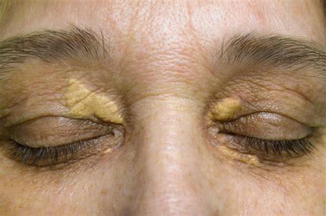 Xanthelasma Treatment Xanthelasma Removal Shumailas