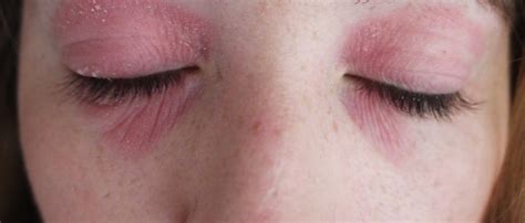 How I Got Rid Of My Eye Eczema Dry Skin Around Eyes Eye Eczema