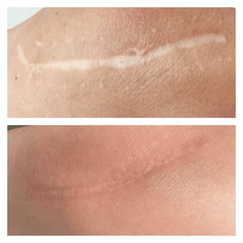 Scar Removal Laser Treatment Nikki Butler Skin Specialist In Hampshire