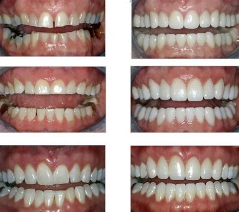 Cosmetic Dentistry Rehabilitation For Generalised Attrition Service