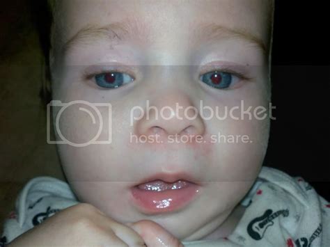 Baby Rash Around Mouth And Nose Get More Anythinks