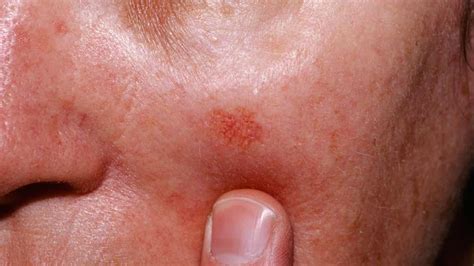 Queratosis Pilar ¿cómo Aliviarla Mejor Con Salud