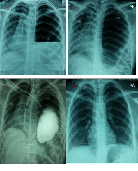 Initial Chest X Ray Of The Patients Showing Left Sided Pneumothorax And