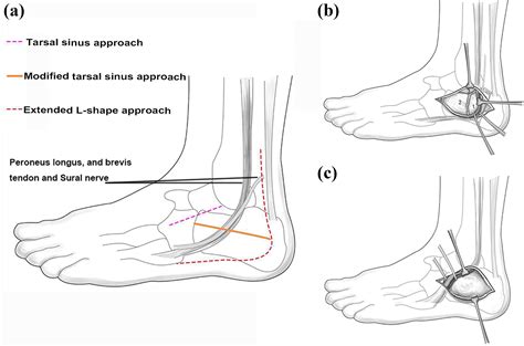 A Modified Tarsal Sinus Approach For Intra Articular Calcaneal