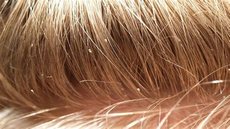 Images Of Lice On Scalp Here Youll Find All The Information You Need