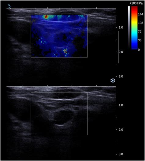 Example Of Parathyroid Adenoma Appearance In Shear Wave Elastography