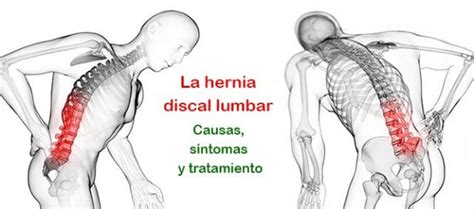 Qué es la hernia discal lumbar Causas síntomas y tratamiento