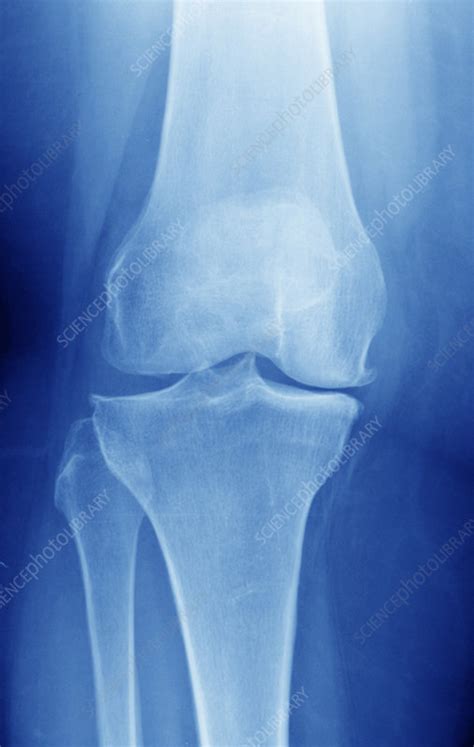 Osteoarthritis Of The Knee X Ray Stock Image C0292442 Science