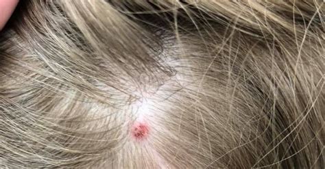Rare Case Of Tick Paralysis Left A 5 Year Old Girl Temporarily Unable
