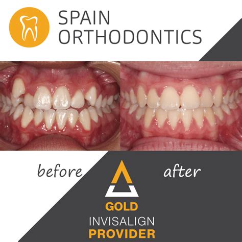 Success Stories Spain Orthodontics