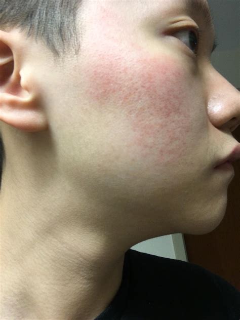 Skin Concerns My Right Cheek Is Quite Red Im Not Sure If Its