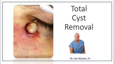 Total Removal Of Facial Cyst