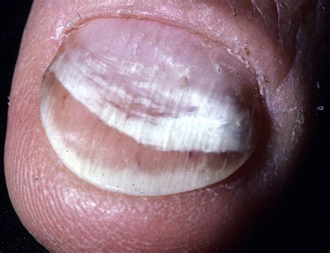 Fungal Nail Infections Journal Of Hand Surgery
