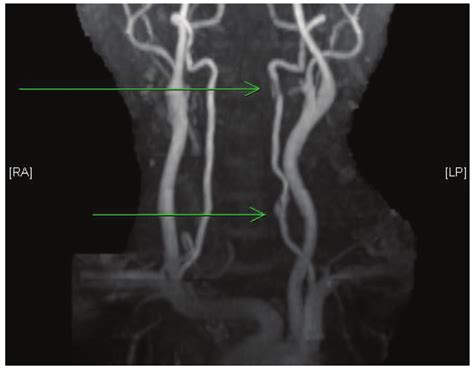 Multifocal Dissection In Left Vertebral Artery C And C Levels Download Scientific Diagram