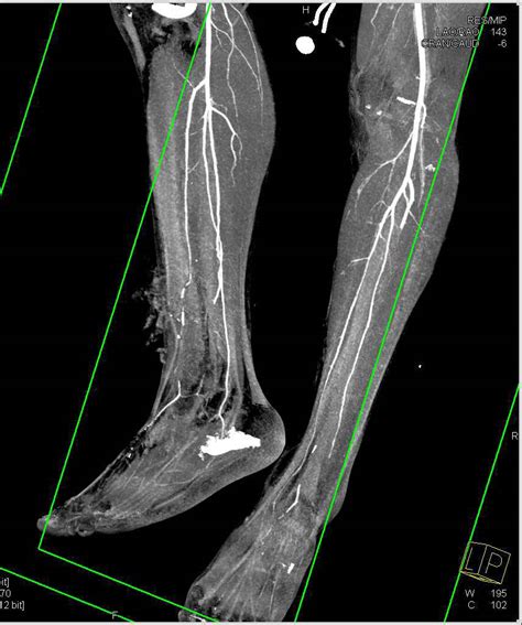 Open Tibial Fracture With Vascular Injury Trauma Case Studies