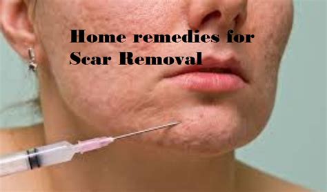 The machine will then gently fire some crystals that will remove the outer layer of the skin causing very little scarring and skin color change. Homemade Acne Scar Removal