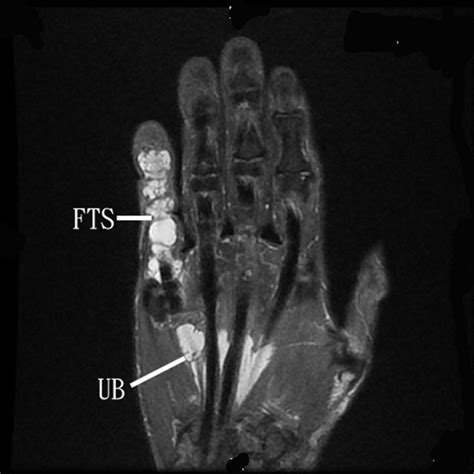 Little Finger Flexor Tendoscopy Endoscopy Of The Ulnar Bursa And