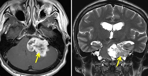 Cerebellopontine Angle Schwannoma Radiology Cases