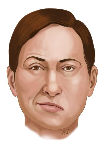 Recurrence can be ipsilateral or contralateral to the original episode. What Is Bell's Palsy? - Neuro Infiny