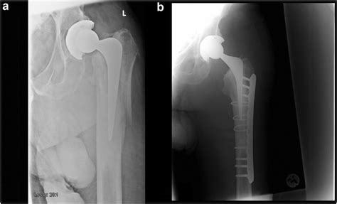 A Periprosthetic Fracture In A Total Hip Arthroplasty B The Same