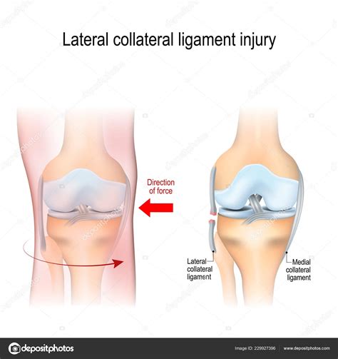 Fibular Collateral Ligament Injury Joint Anatomy Vector Illustration Biological Medical Stock