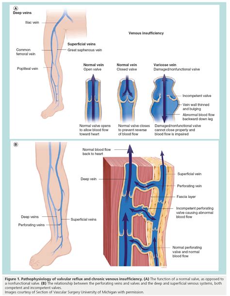 Venous Vs Arterial Insufficiency Chart A Visual Reference Of Charts