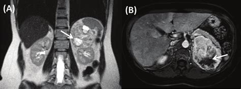 Adrenal Cortical Carcinoma Magnetic Resonance Imaging Coronal