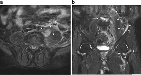 Fast Stir Magnetic Resonance Imaging Of Iliopsoas Hematoma A Axial