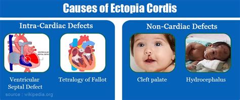 Ectopia Cordis Causes Symptoms Diagnosis Complications Treatment