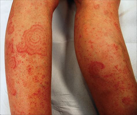 erythema gyratum repens induced by pegylated interferon alfa for chronic hepatitis c oncology