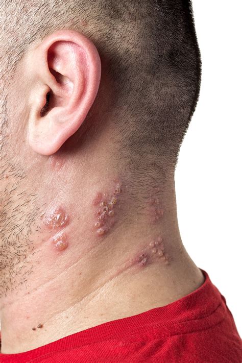 Contact us today for details. SHINGLES