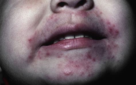 Red rash around the mouth can happen to people of all ages, race or. That rash around your mouth might be perioral dermatitis