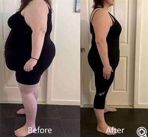 Before Vs After Gastric Sleeve Bariatric Sleeve Bariatric Sleeve