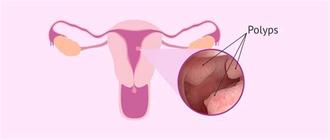 Malignant Uterine Polyps Types Symptoms And Treatments