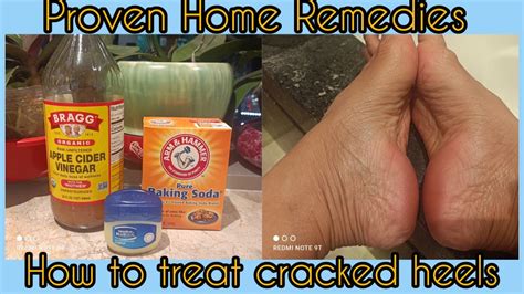 How To Use Apple Cider Vinegar And Baking Soda As A Treatment For