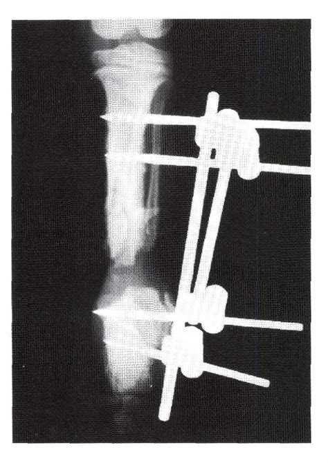 Figure 3 From Callus Distraction Method For Open Tibial Fracture With