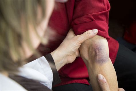 Common Reasons Youre Bruising So Easily Geelong Medical And Health Group
