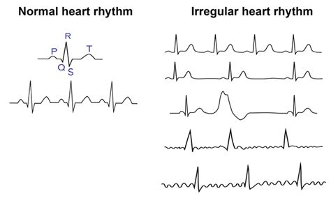 Safebeat Initiative Did Your Heart Skip A Beat All About Arrhythmias