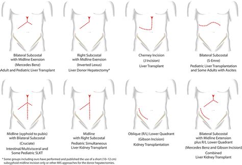 Surgical Approach To Abdominal Wall Defects And Hernias In Patients