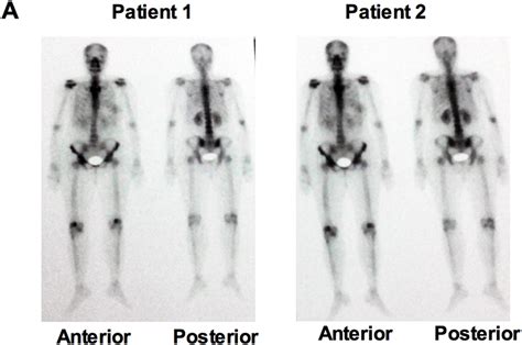 Bone Metastasis And Elevated Levels Of Shh And Il 6 In Progressive
