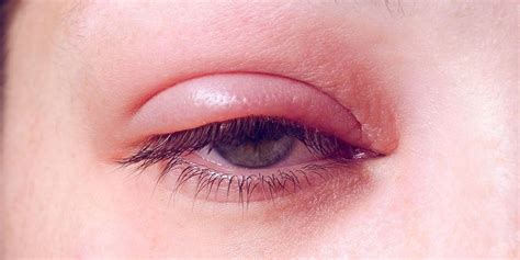 Kelopak mata bawah bengkak yang muncul setelah seseorang menangis merupakan hasil dari retensi cairan yang disebabkan oleh peningkatan aliran darah ke daerah sekitar mata. Benjolan Di Kelopak Mata Pada Anak - Rajiman