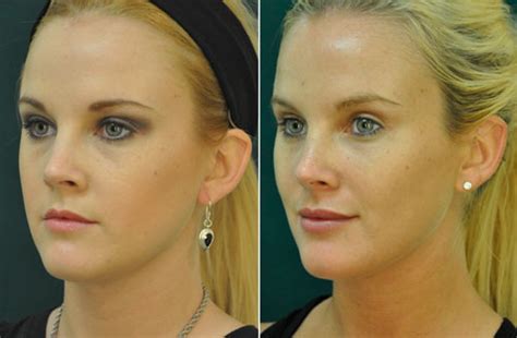Fat Grafting Of The Face Dr Dirk Lazarus Plastic Surgeon