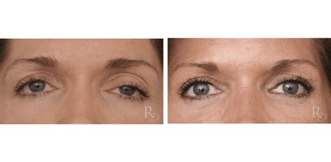 Ptosis Before After Success Stories Raymond Douglas