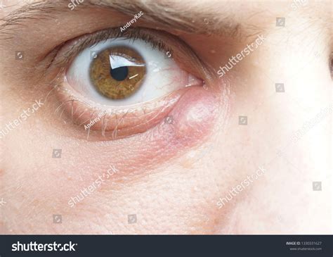 Young Boiled Out Big Boil Under Stock Photo 1330331627 Shutterstock