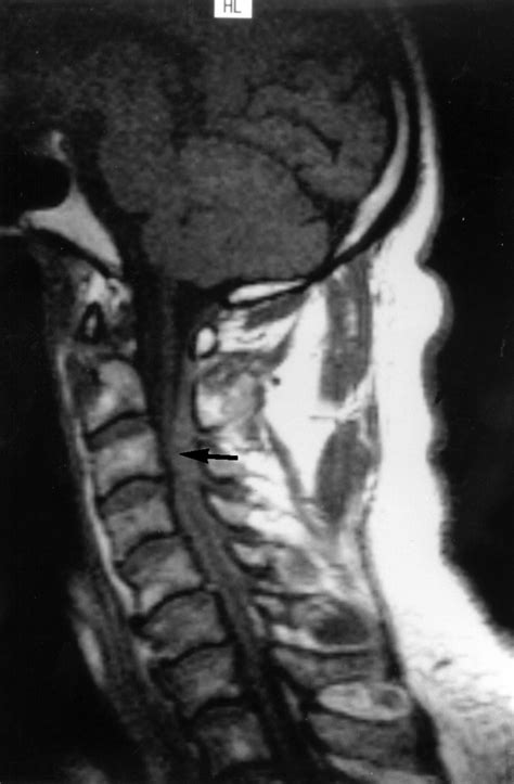 Spontaneous Spinal Epidural Haematoma An Unusual Cause Of Neck Pain