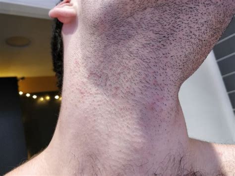 Ingrown hairs occur when individual hairs grow at a slant, usually a result of improper shaving apply a warm compress to the bottom of the scrotum to soften the hair and open hair follicles. Best 25+ Ingrown hair on neck ideas on Pinterest | Rosecea ...