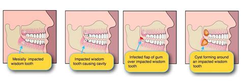 Do I Need To Remove My Wisdom Tooth South Perth Dental Excellence