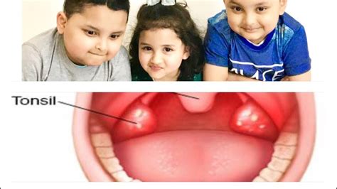 How To Make Tonsils Smaller Home Remedies For Tonsillitis Natural